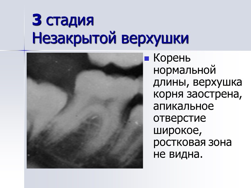 3 стадия  Незакрытой верхушки Корень нормальной длины, верхушка корня заострена, апикальное отверстие широкое,